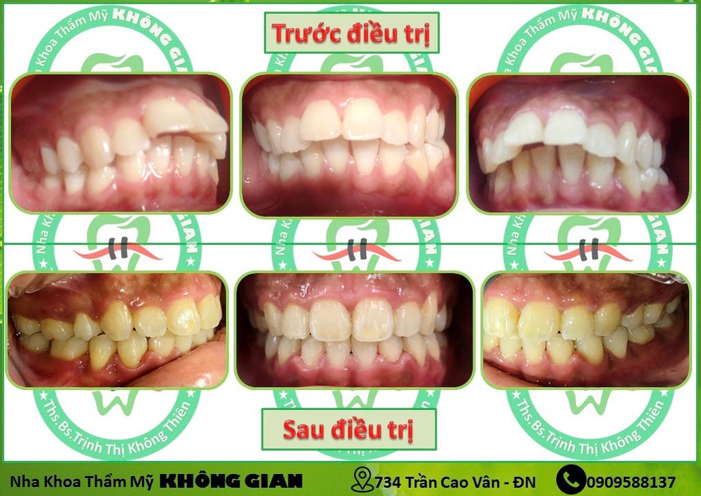 Hình ảnh so sánh trước và sau khi điều trị