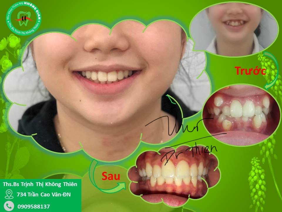 Hình ảnh so sánh trước và sau khi điều trị