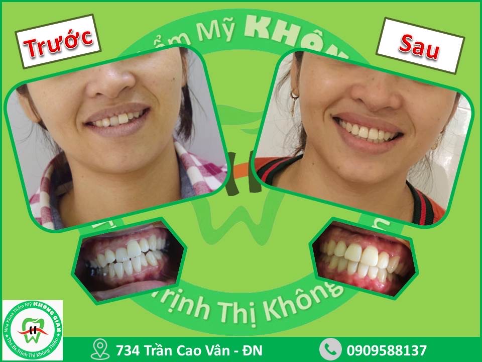Hình ảnh so sánh trước và sau khi điều trị