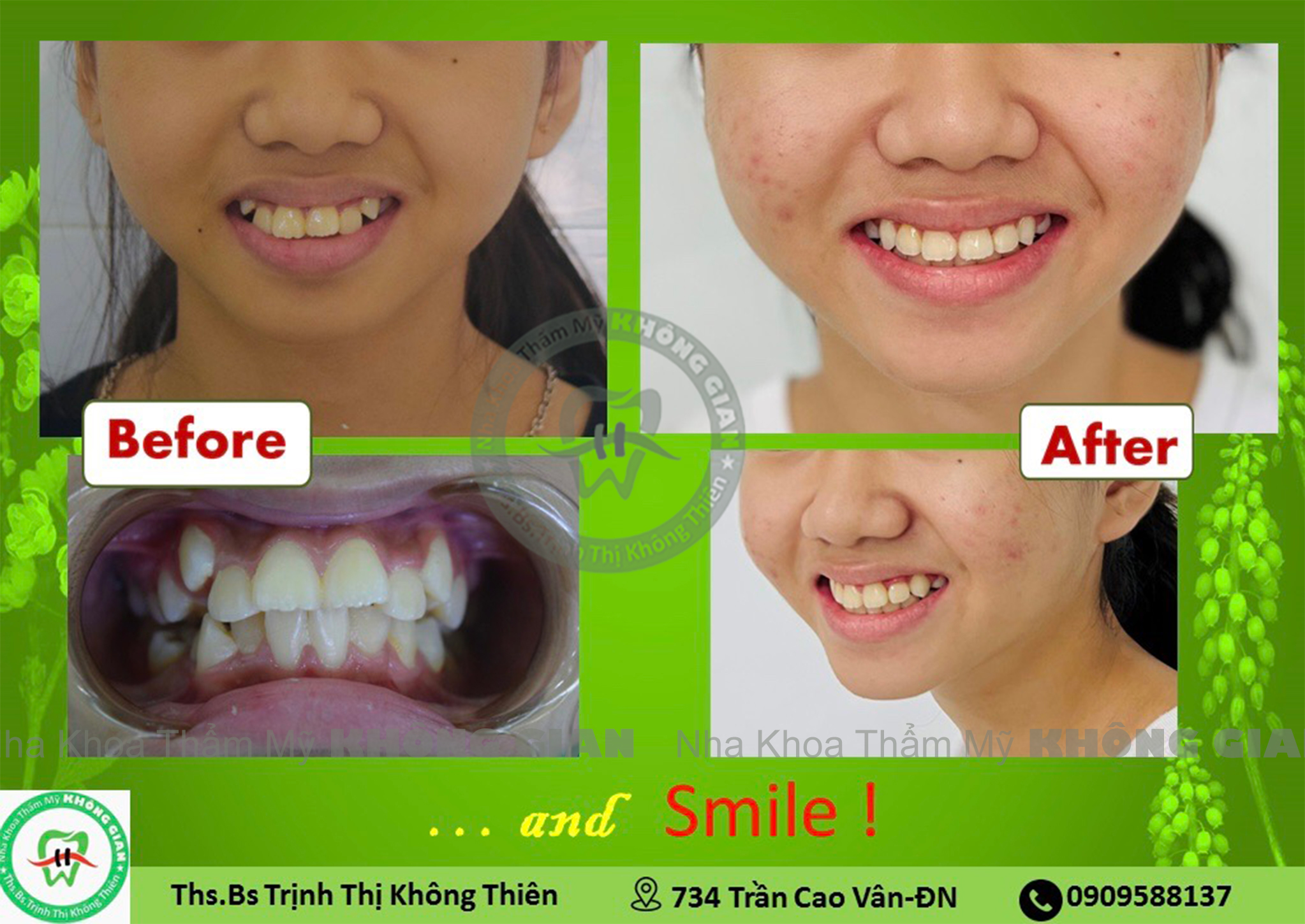 Hình ảnh so sánh trước và sau khi niềng răng